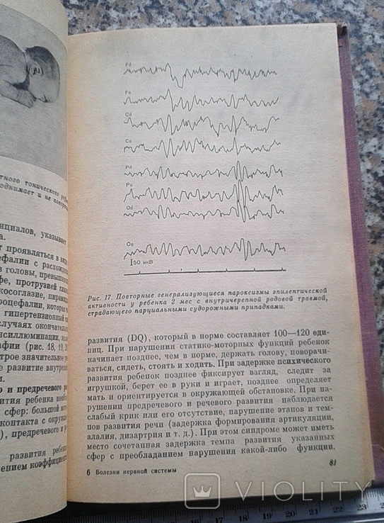Болезни нервной системы у новорожденных 1979, фото №5