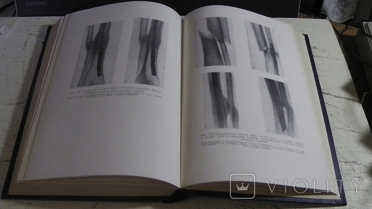 Книга: Повреждение костей и суставов. Каплан 1