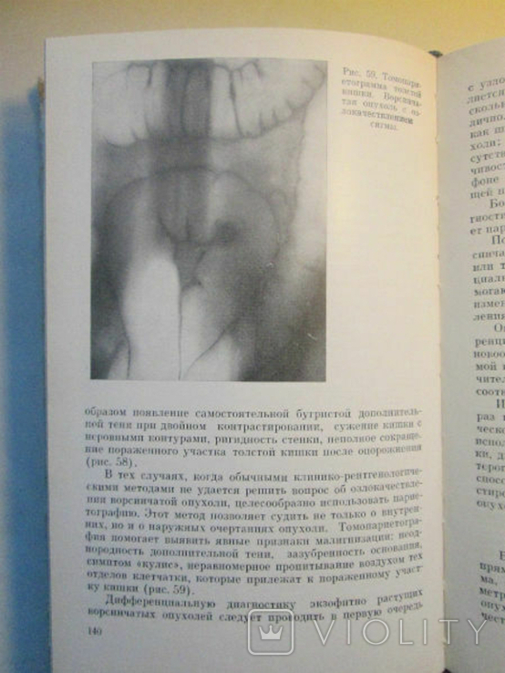 X-ray diagnosis of tumors of the rectum and colon., photo number 6