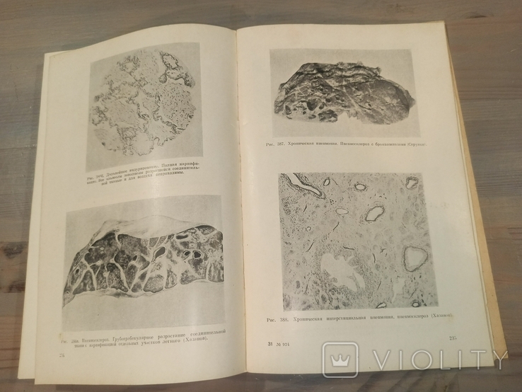 Диференціальна діагностика захворювань легенів. 601 малюнок. 1950., фото №5
