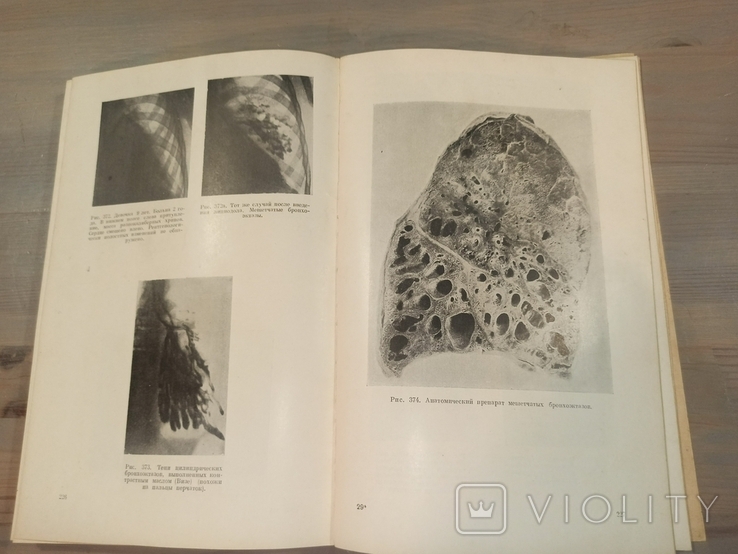 Диференціальна діагностика захворювань легенів. 601 малюнок. 1950., фото №6