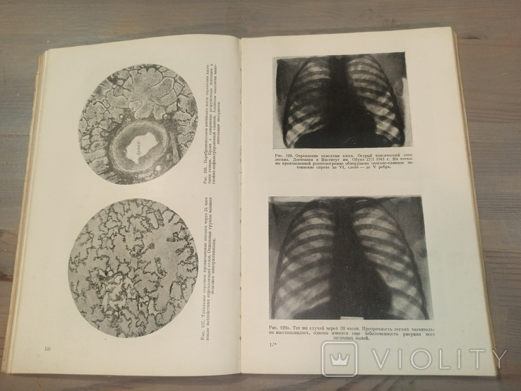 Диференціальна діагностика захворювань легенів. 601 малюнок. 1950., фото №8