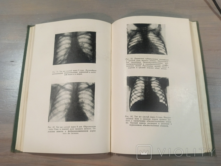 Епідеміологія та патогенез туберкульозу легень. 1948. Тираж 4000., фото №7