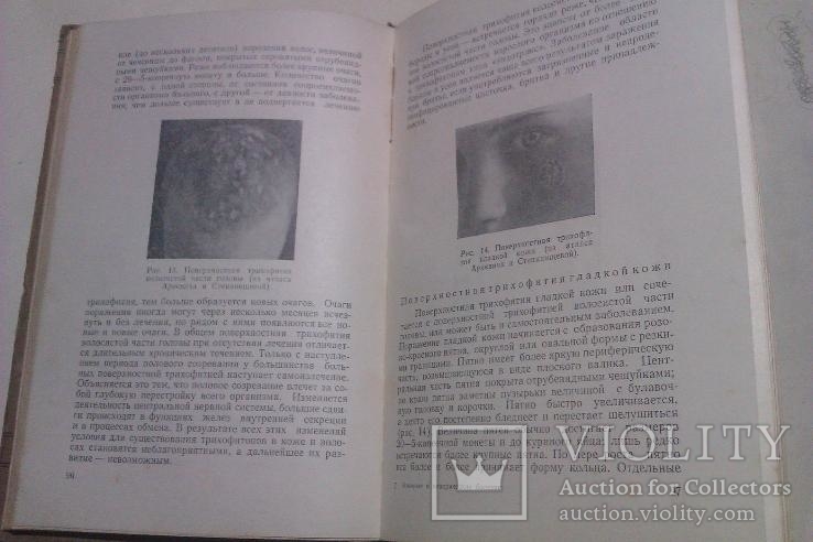 Фандеев Л. И. Кожные и венерические болезни. М. Медгиз 1954г., фото №5