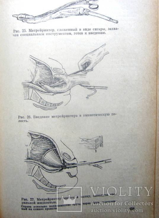 Маточные кровотечения в акушерстве.1970 г., фото №9