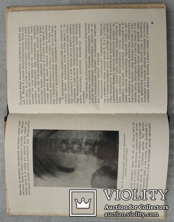 Хирургические операции на желчных путях 1961 г. Тираж 10000., фото №5