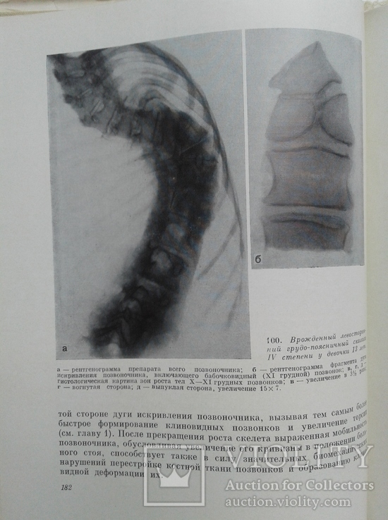 Рентгенодиагностика и принципы лечения сколиоза, фото №8