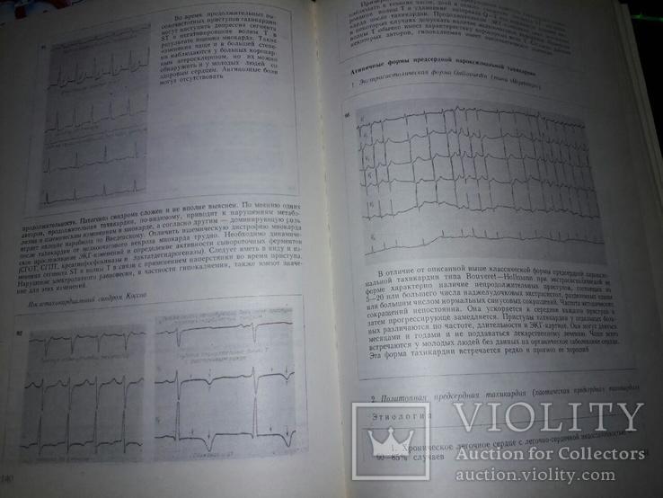 Книга "Нарушения ритма сердца" проф.Л.Томов,доц.И.Л.Томов 1976 год, фото №5