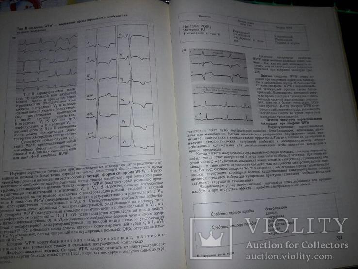 Книга "Нарушения ритма сердца" проф.Л.Томов,доц.И.Л.Томов 1976 год, фото №8
