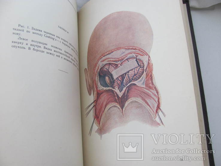 Поленов А.Л. Атлас операций на головном и спинном мозге 1945 г., фото №12
