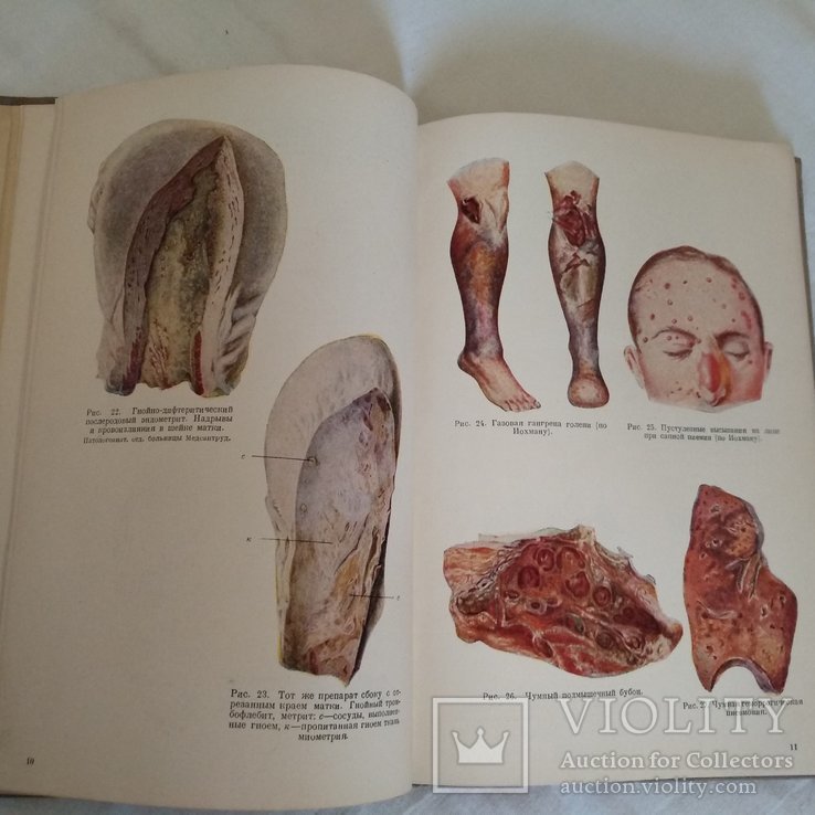 1938 Патологическая анатомия Болезни человека Атлас рисонков