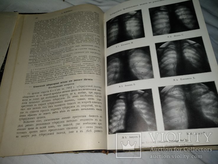 1911 Туберкулёз диагностика имунитет лечение медицина, фото №5