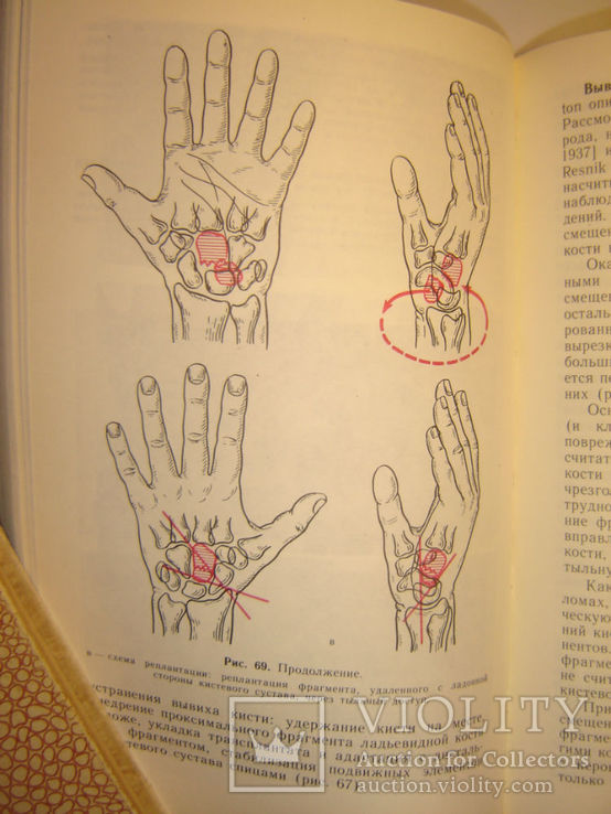 Хирургия кистевого сустава., фото №5