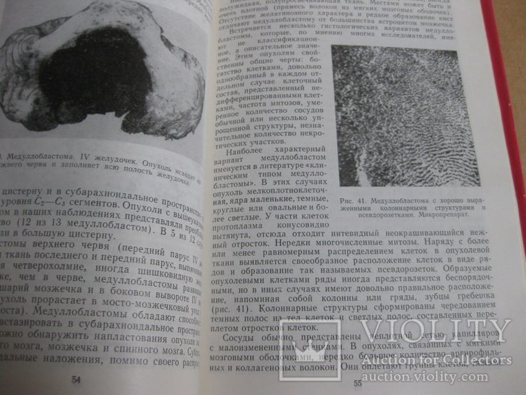 Опухоли желудочковой системы головного мозга. 1973, фото №7