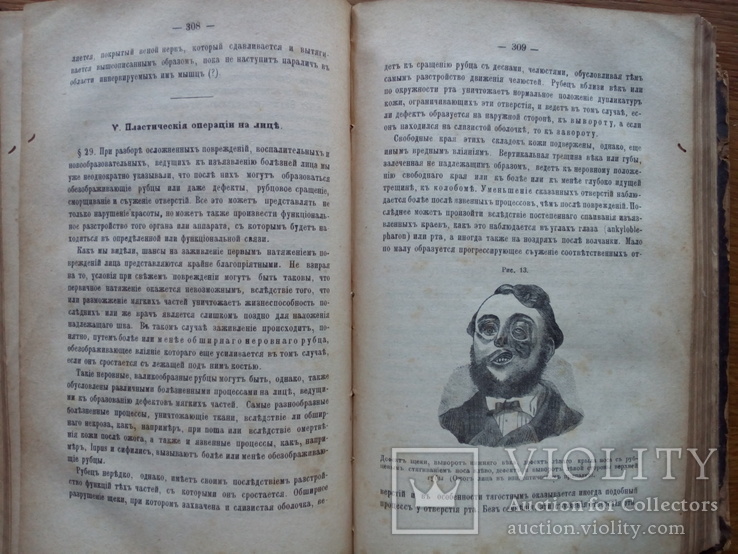 Пластические операции хирургия 1886 С иллюстрациями, фото №4