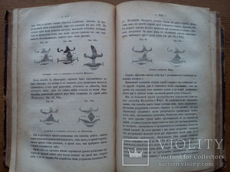 Пластические операции хирургия 1886 С иллюстрациями, фото №6