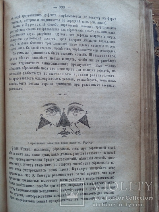 Пластические операции хирургия 1886 С иллюстрациями, фото №9