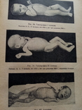 Пропедевтика детских болезней. 1955г., фото №7