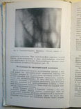 X-ray diagnosis of tumors of the rectum and colon., photo number 5