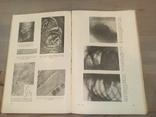 Диференціальна діагностика захворювань легенів. 601 малюнок. 1950., фото №7