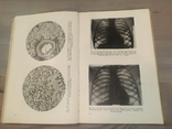 Диференціальна діагностика захворювань легенів. 601 малюнок. 1950., фото №8