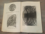 Диференціальна діагностика захворювань легенів. 601 малюнок. 1950., фото №10