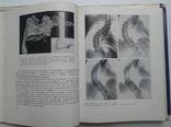 Рентгенодиагностика и принципы лечения сколиоза, фото №7