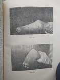 Болезни культей нижних конечностей и их лечение, фото №5