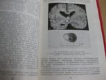 Опухоли желудочковой системы головного мозга. 1973, фото №5