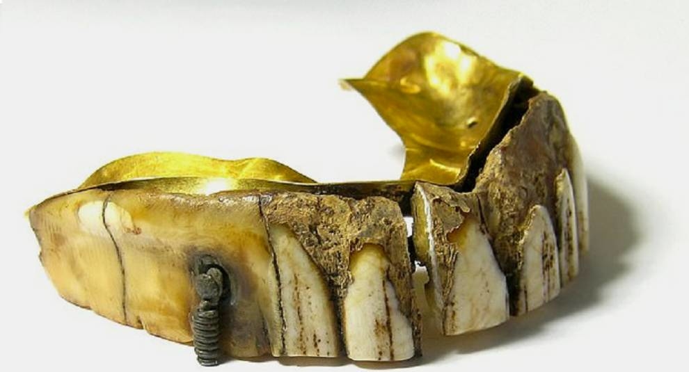 Precious jaw: false teeth found in England the century before last