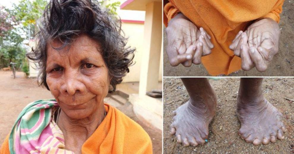 They shouted together — a witch! Due to a rare pathology, Indian women are credited with witchcraft abilities (Photo)